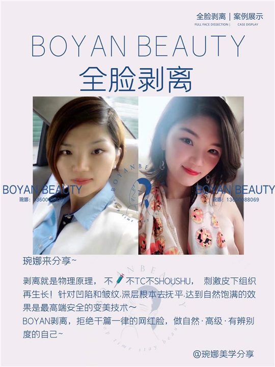 全脸剥离