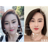 广州博妍植发需要多少钱？