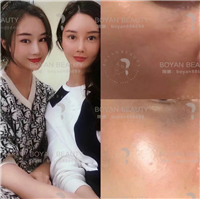印第安纹剥离