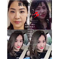 印第安纹剥离