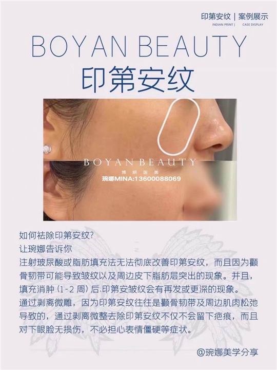 剥离微雕