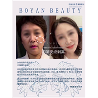 剥离微雕价格