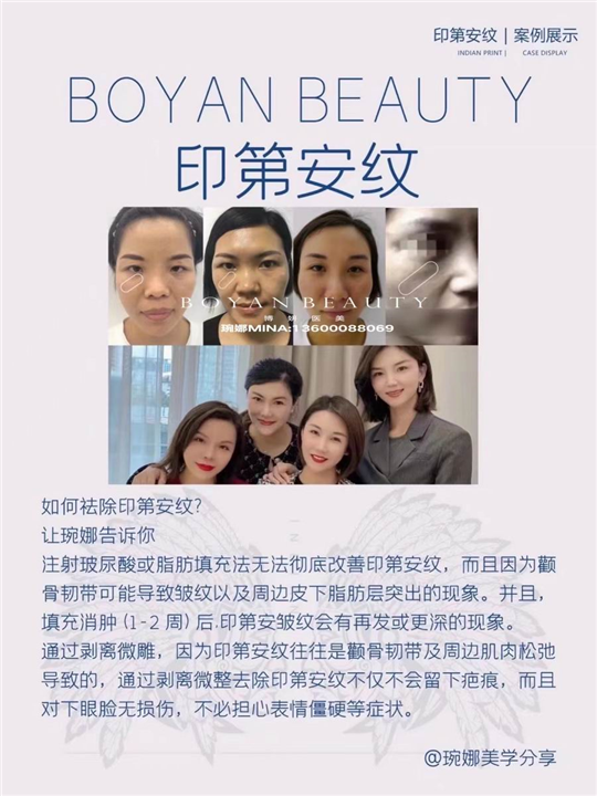剥离微雕