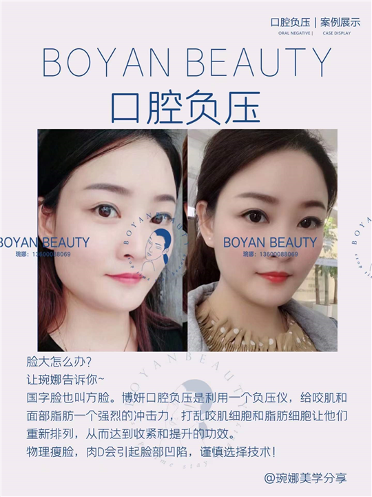 口腔负压瘦脸