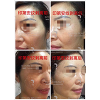 剥离微雕价格