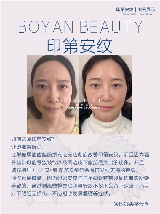 剥离微雕