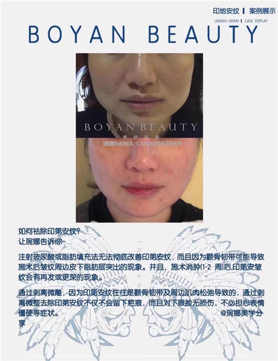剥离微雕价格