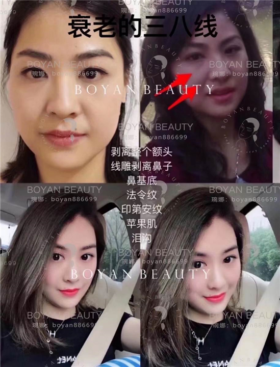 印第安纹剥离