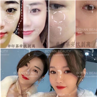 印第安纹剥离