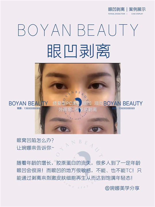眼凹剥离