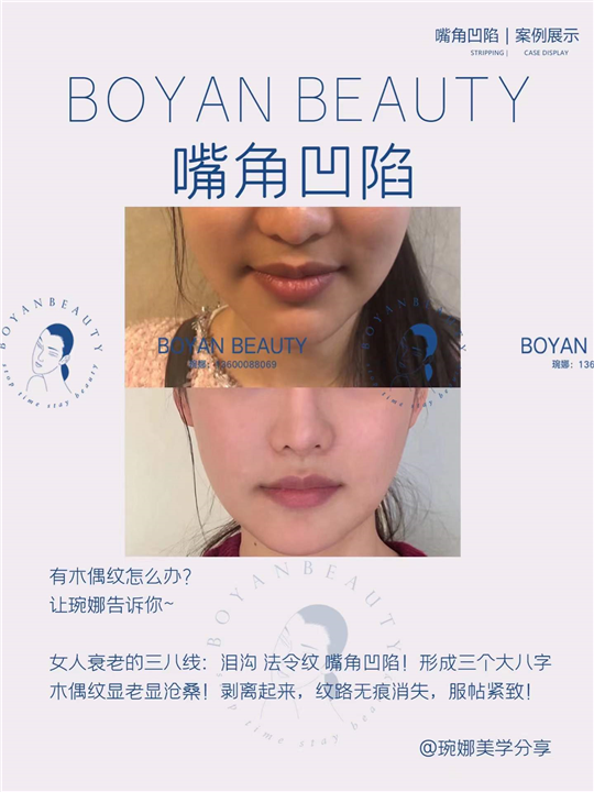 嘴角凹陷