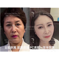 印第安纹剥离