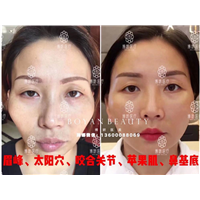 剥离微整费用