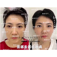 剥离微整费用