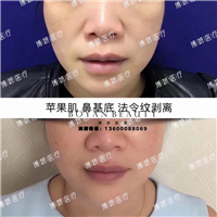 剥离微整费用