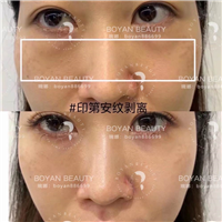 印第安纹剥离