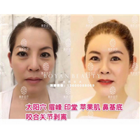 剥离微整费用