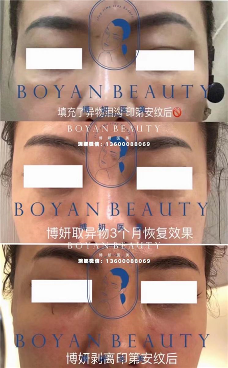 剥离微整费用