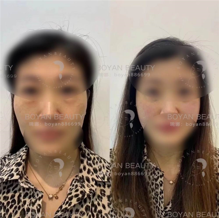剥离微雕价格