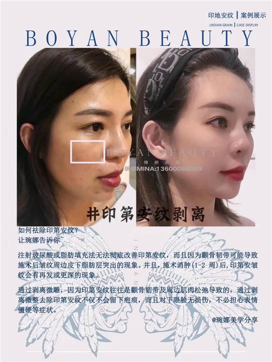 剥离微雕价格