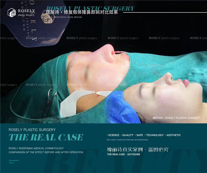 瑰丽诗修复自体软骨隆鼻