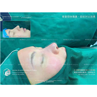 广州瑰丽诗修复假体隆鼻