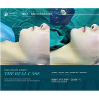 瑰丽诗假体下巴