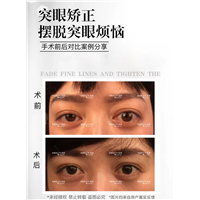 成都陈辉医生突眼案例