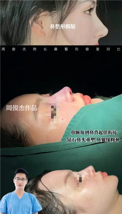 周俊杰鼻整形怎么样