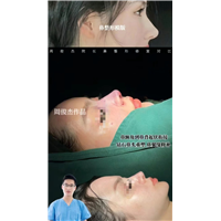 周俊杰鼻整形怎么样