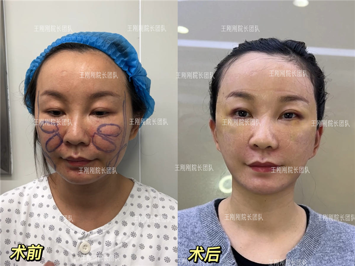 上海王刚刚医生拉皮案例