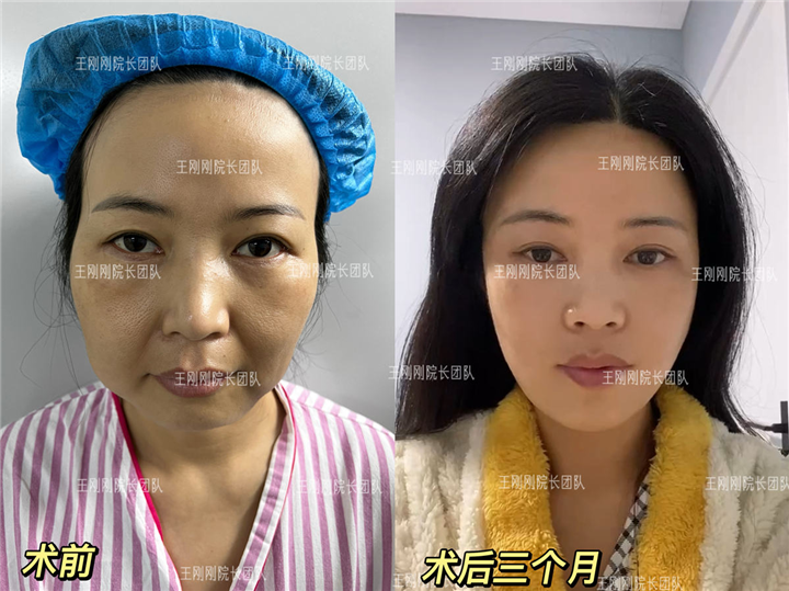 上海王刚刚拉皮案例