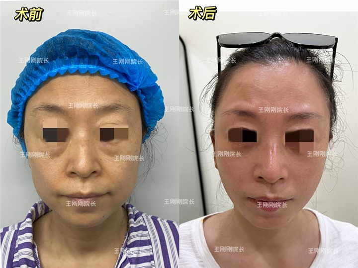 上海mini小拉皮术后