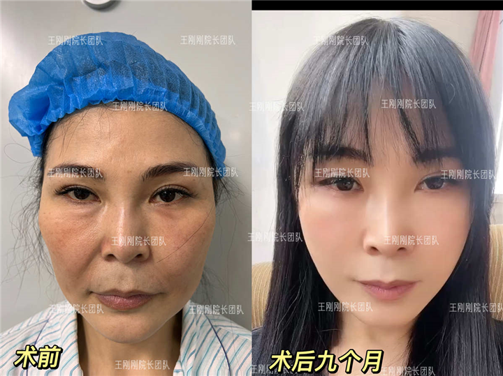 上海拉皮手术疼吗