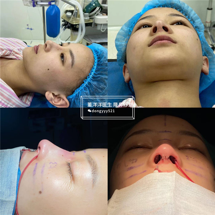 上海隆鼻修复医生推荐董洋洋