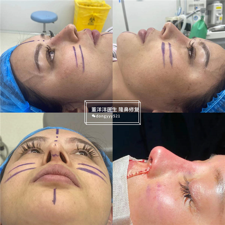 董洋洋鼻整形案例