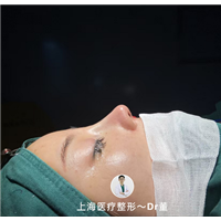 上海鼻整形有名的医生董洋洋 