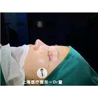 董洋洋肋骨鼻修复整形 