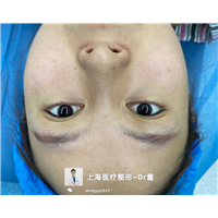 董洋洋眼综合整形案例分享 