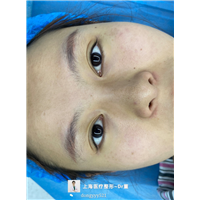 上海双眼皮整形医生推荐董洋洋 