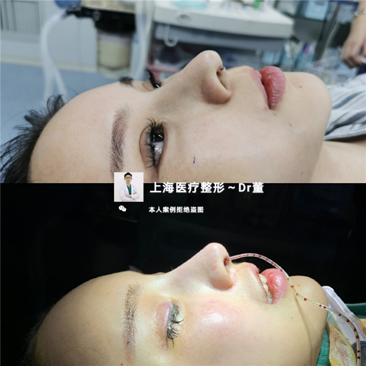 上海董洋洋医生肋骨鼻修复案例 