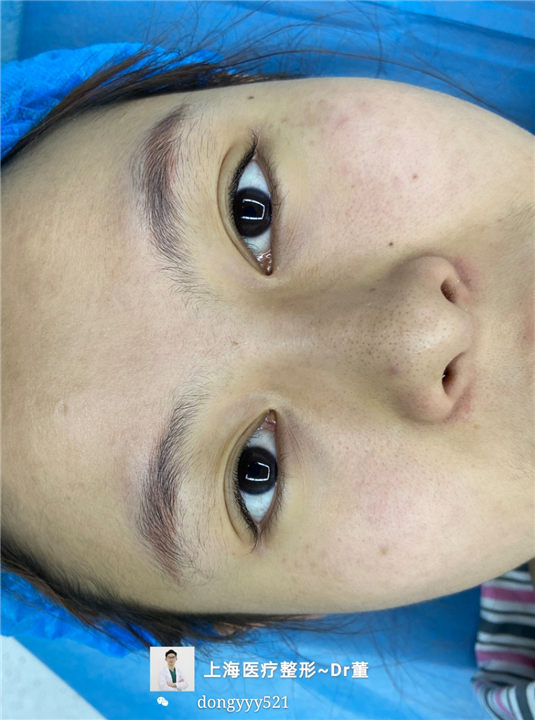 上海双眼皮整形医生推荐董洋洋 