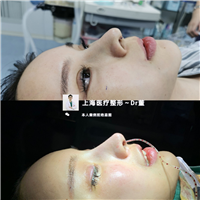上海董洋洋医生肋骨鼻修复案例 