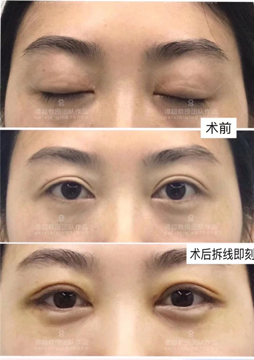 武汉谭超院长做双眼皮怎么样
