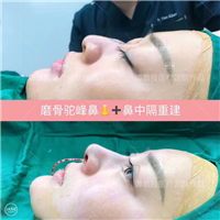 武汉鼻整形修复医生
