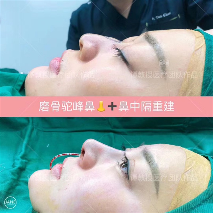 谭超医生驼峰鼻打造术后即刻