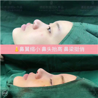 武汉鼻整形专家