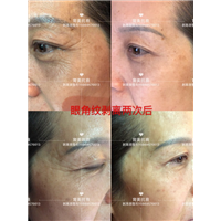 印第安纹剥离微整