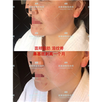 北京剥离微整