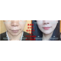 北京剥离微整